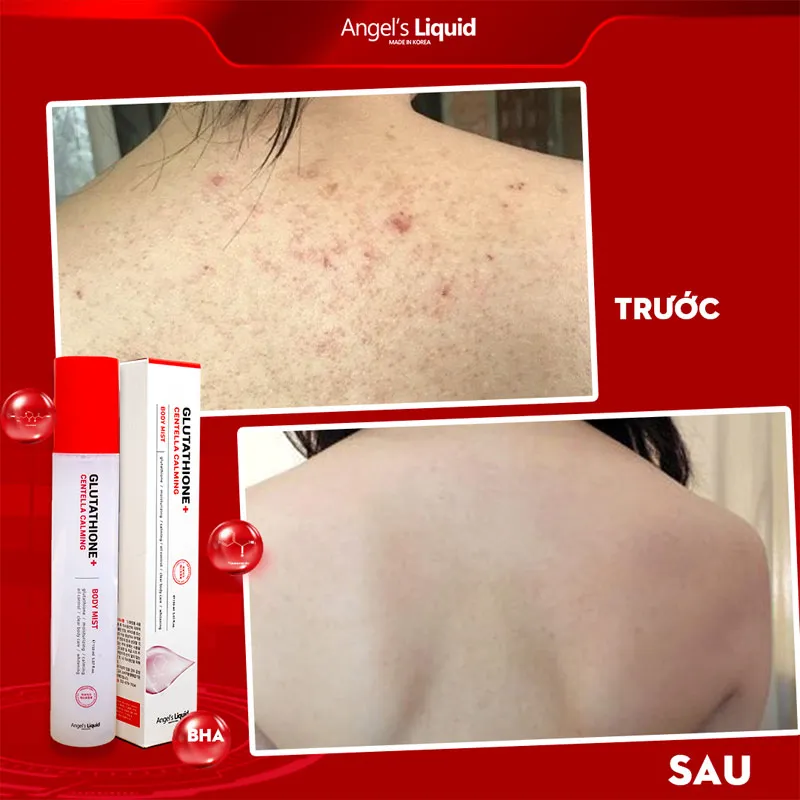 Xịt Giảm Mụn Lưng Angel's Liquid